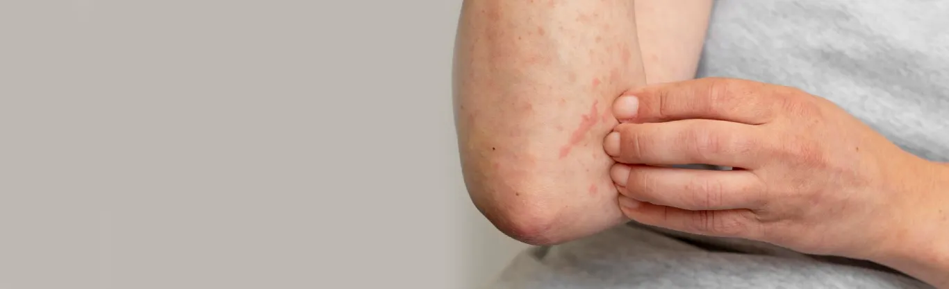 Eczema Treatment