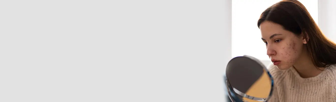 Acne Treatment in Delhi