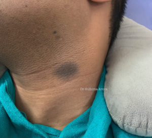 Get Rid of Acne Scars: Prevention and Treatment Options for Healthy Skin